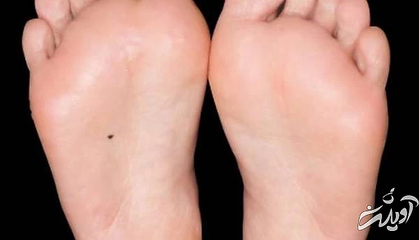 شخصیت شناسی از روی خال پاها خال در پاها